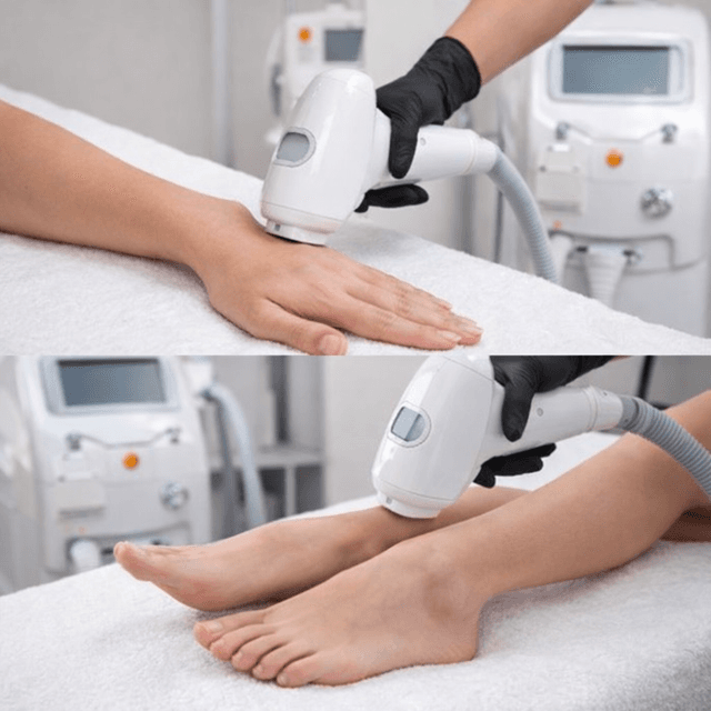 Depilación Láser en manos o pies at Universal Skin Care in Aguada, PR